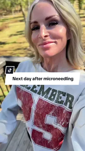 Depths can be different for everyone depending on skin and concerns. These are just BASIC guidelines I went by. Microneedling might look intense, but it’s one of the best things you can do for aging skin….as long as everything is kept extremely sanitary!  Your face, tools, workspace, everything has to be clean. Microneedling creates controlled micro-injuries that trigger your body’s natural collagen and elastin production. Over time, that helps smooth fine lines, fade dark spots, and improve overall texture. It’s basically your skin’s “reset” button #microneedling #A#AtHomeMicroneedlingbeautyover40 #skintightening #GlowingSkin
