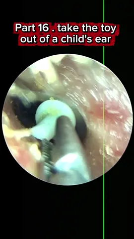 Part16 take the toy out of a child's ear #tiktokawardsusa2025 #earcleaningasmr #satisfyingasmrtingsounds #earwax #tiktokawards 