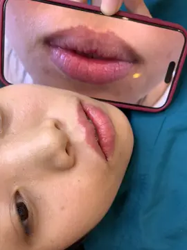 Cắt tạo hình môi tại Bắc Ninh #xuhuong2024 #bacninh #catmoi #cắtmoidep #sửamoiloi 