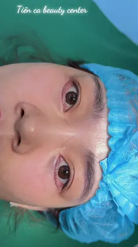 ✨ Cắt mí dưới – khơi dậy ánh nhìn tinh tế Mí dưới thon gọn, tươi trẻ giúp đôi mắt trở nên cuốn hút và đầy sức sống hơn. Tại Mỹ Tiên Beauty Center, mỗi đường cắt đều được thực hiện tỉ mỉ, tinh tế – mang lại kết quả tự nhiên và an toàn tuyệt đối 💚 💬 Tư vấn ngay để “tái sinh” ánh nhìn của bạn!