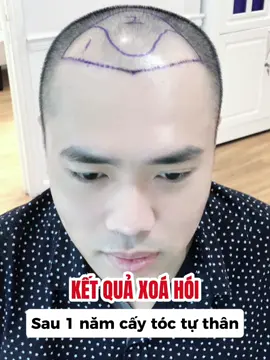 KẾT QUẢ XOÁ HÓI SAU 1 NĂM CẤY TÓC #caytoc #caytoctuthan  #hanhtrinhcaytoc  #ketquacaytoc  #xuhuongtiktok 