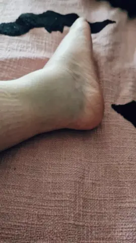 Bruising is coming out thanks to Arnica gel. Swelling is spreading to the top of the foot, towards the toes. Moving it a bit better though, but still unstable, so grateful for the splint and crutches. #lateralanklesprain #bruises #arnicagel #sprainedankle #grade3sprain 