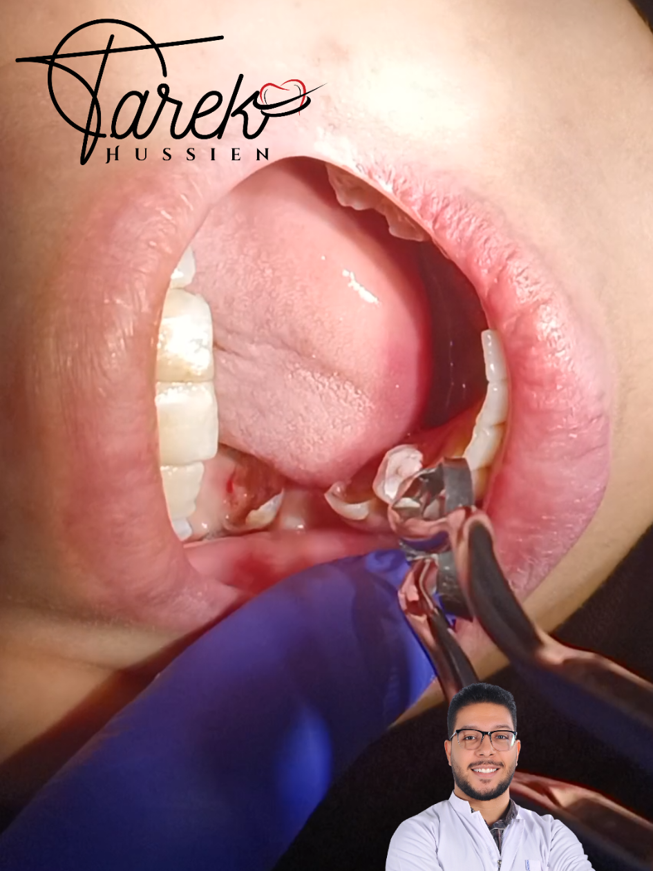 isolation tricks 💥  #Tarek_Hussien #trending #dentist #explore #isolation 