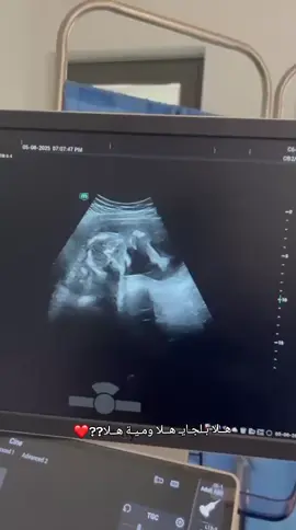 بعد شهرين ♥♥♥🥹  #بنتي #CapCut #بنات #تجهيزات #اكسبلور 