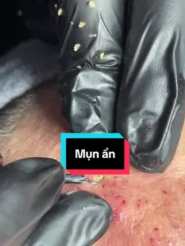 Nghiện nặn mụn #trimun #dieutrimunchuyensau #munan#
