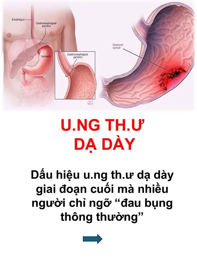 Dấu hiệu của u.ng th.ư dạ dày #tiktok #viral #daday #ungthu 