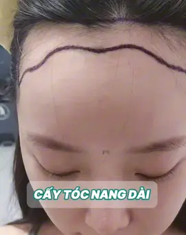 Cấy tóc nang dài#TikTokAwardsVN #thammy #bsthaomi #viralvideo #pttm 