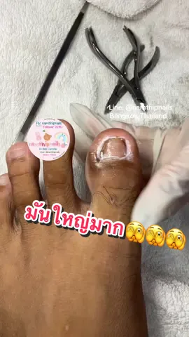 💓 #namthipnails #ตัดเล็บขบ #ตัดหนัง #ทำเล็บ #ร้านตัดเล็บขบ      Fb : namthipnails  Line : @namthipnails