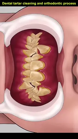#tooth #teeth #dental #tartar #cleaning #orthodontic #process #foryou #fyp 