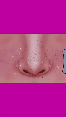 blackheads #animation #ASMR #Satisfying #CartoonCleaning #skincare #blackhead 