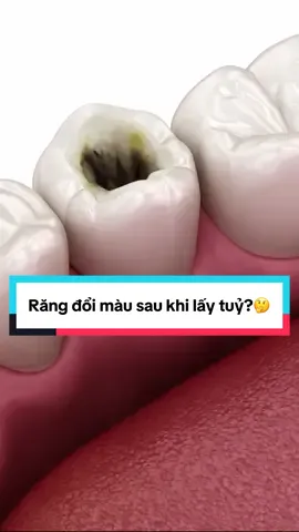 Răng đổi màu sau khi lấy tuỷ? 🤔 #nhakhoavananh #nhakhoauytin #dieutrituy #nhakhoa #xuhuong 