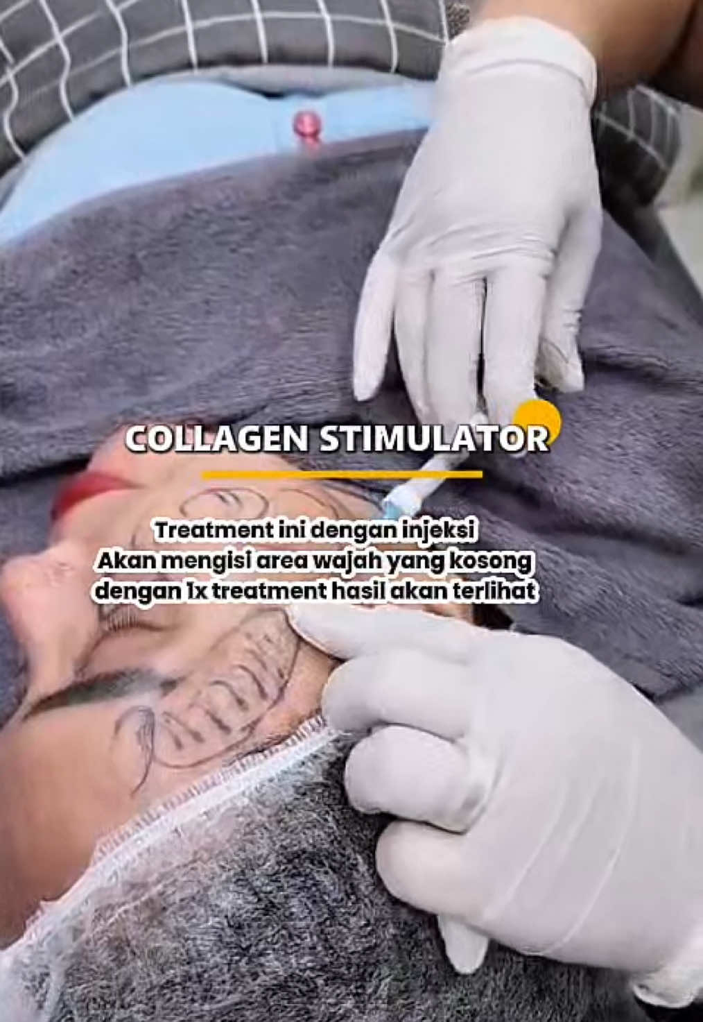 Yuk cobain kolagen stimulator…  #klinikkecantikanjakarta #klinikkecantikandepok #klinikkecantikan #kolagenstimulator #kolagenstimulator #kolagenstimulator #klinikkecantikandepok #klinikkecantikanjakarta 
