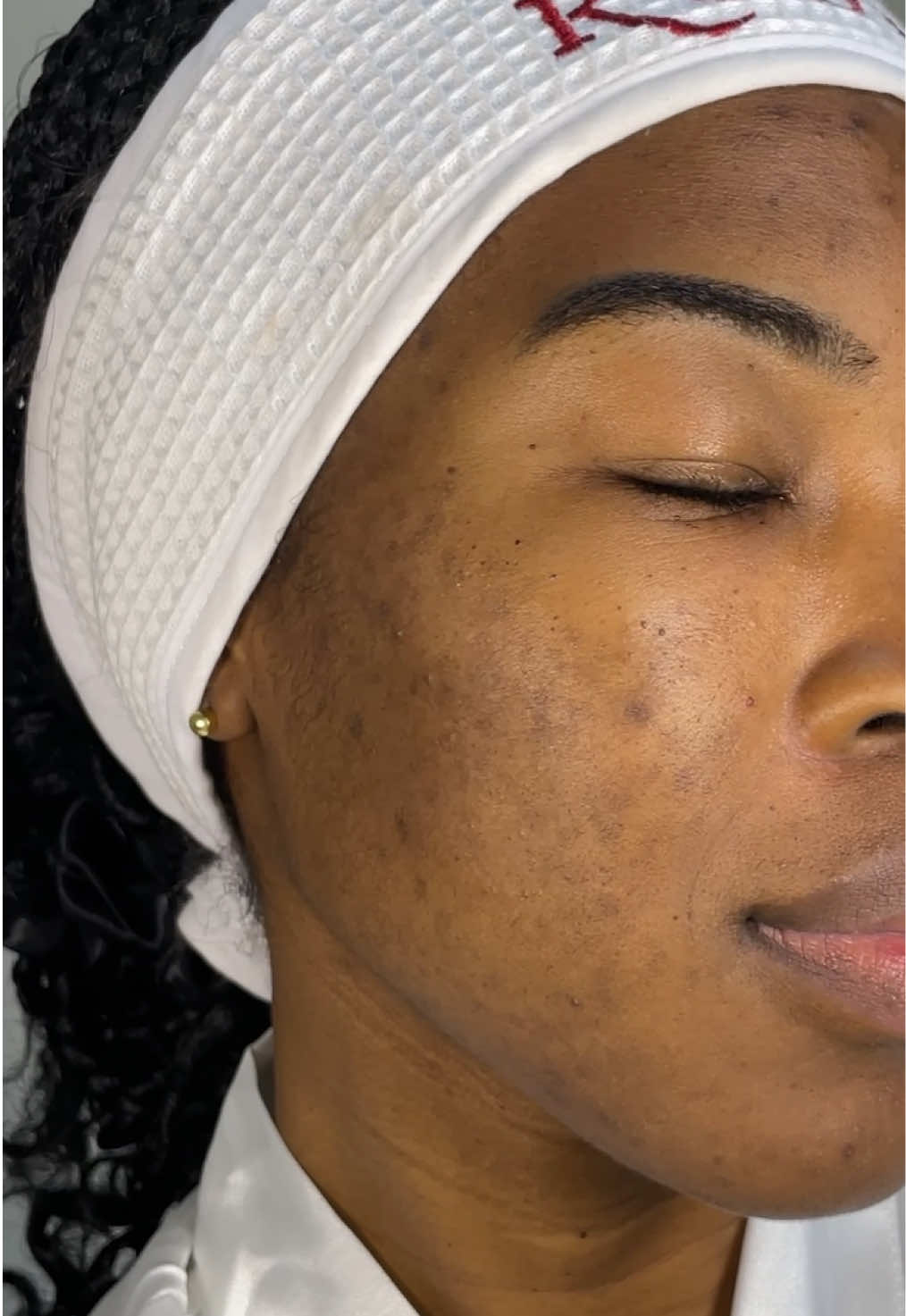 I’m so happy with my skin right now..no filters, just progress🤭🥰 all thanks to @African Extracts  . . #acnejourney🥺 #acnehealing #beforeafter #skintransformation #acnesolution 