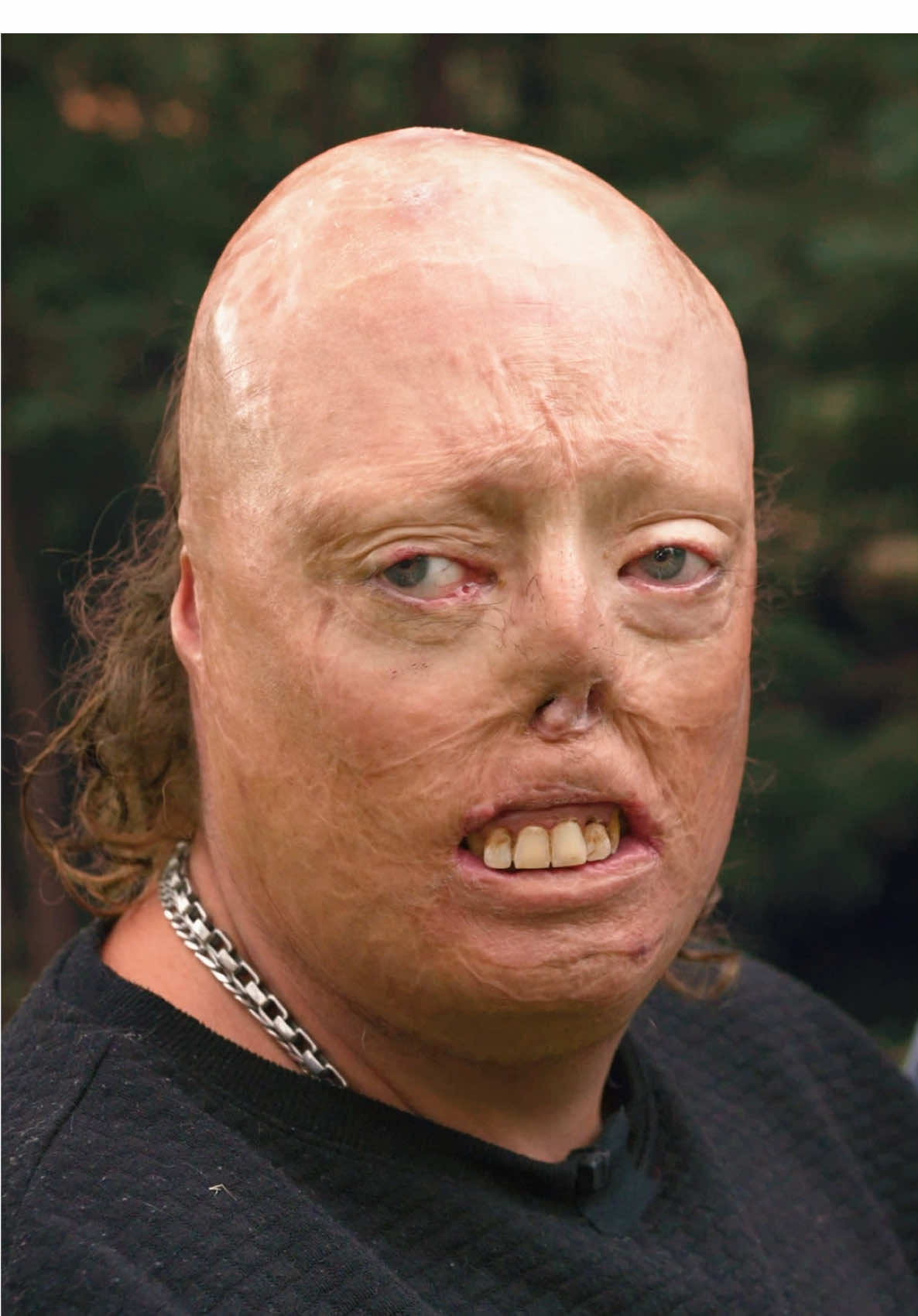 J’ai été brûlé lors d’un incendie de camping à l’âge de 9 mois, je n’étais encore qu’un bébé. 💔🙏🏻 #incendie #histoire #cicatrices #feu #caravan