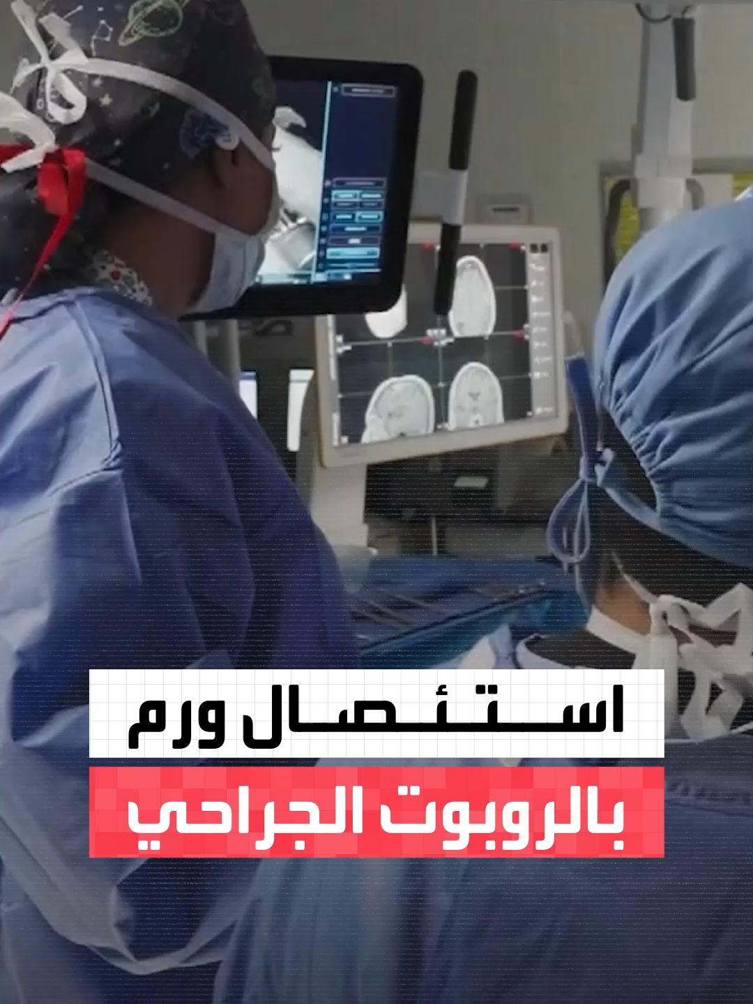 لأول مرة في العالم.. استئصال ورم دماغي بحجم 4.5 سم باستخدام الروبوت الجراحي في مستشفى الملك فيصل التخصصي في العاصمة #السعودية الرياض #نشرة_الرابعة #قناة_العربية