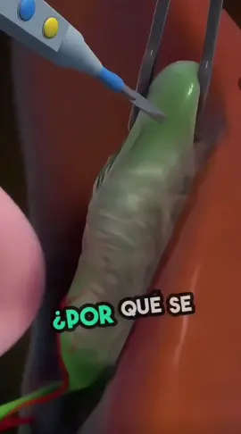 ¿Porque retirar la vesícula biliar? #vesiculabiliar #inflamacion #calculos 