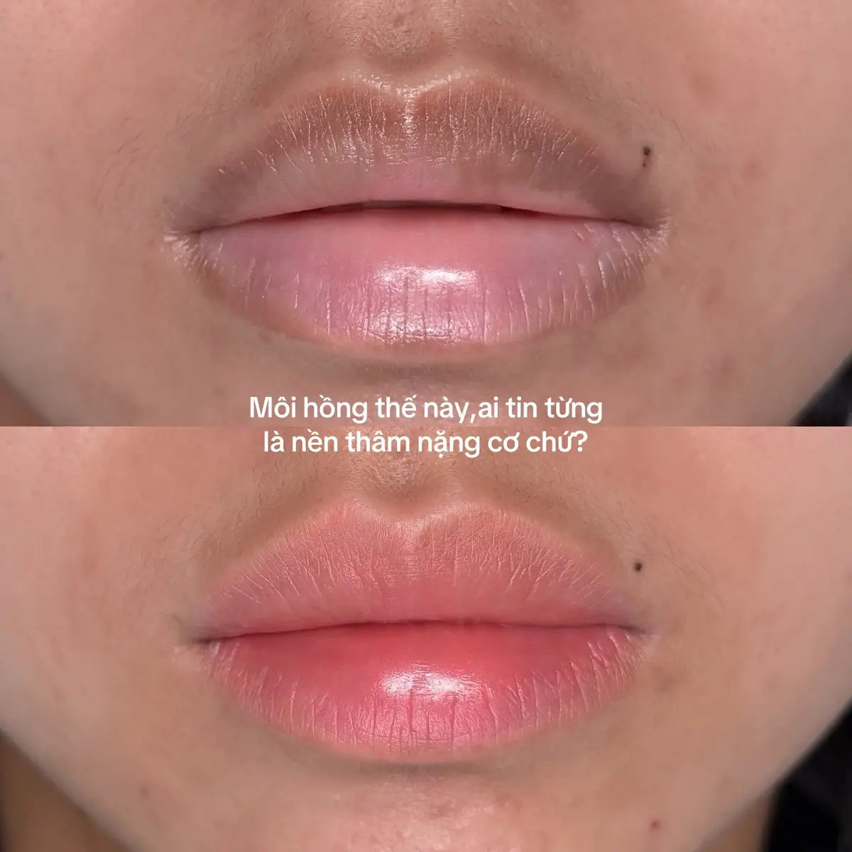Nếu bạn biết được đây là kết quả sau một buổi khử thâm,chắc bạn sẽ tiếc vì chưa làm sớm hơn.#phunxamcantho #khuthammoinam 