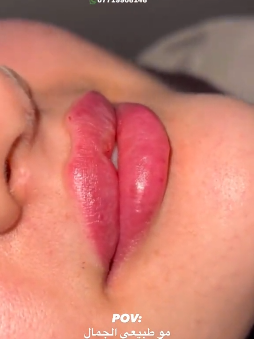 الفلر يم النور وبس🙂‍↔️💕👌#مركز_النور_للتجميل_ميسان #for #صالون #فلر #x 