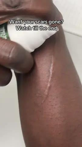 Remove old and new scars and also stretchmarks with this scar gel removal #stretchmarks #scars #scargel #fyp 