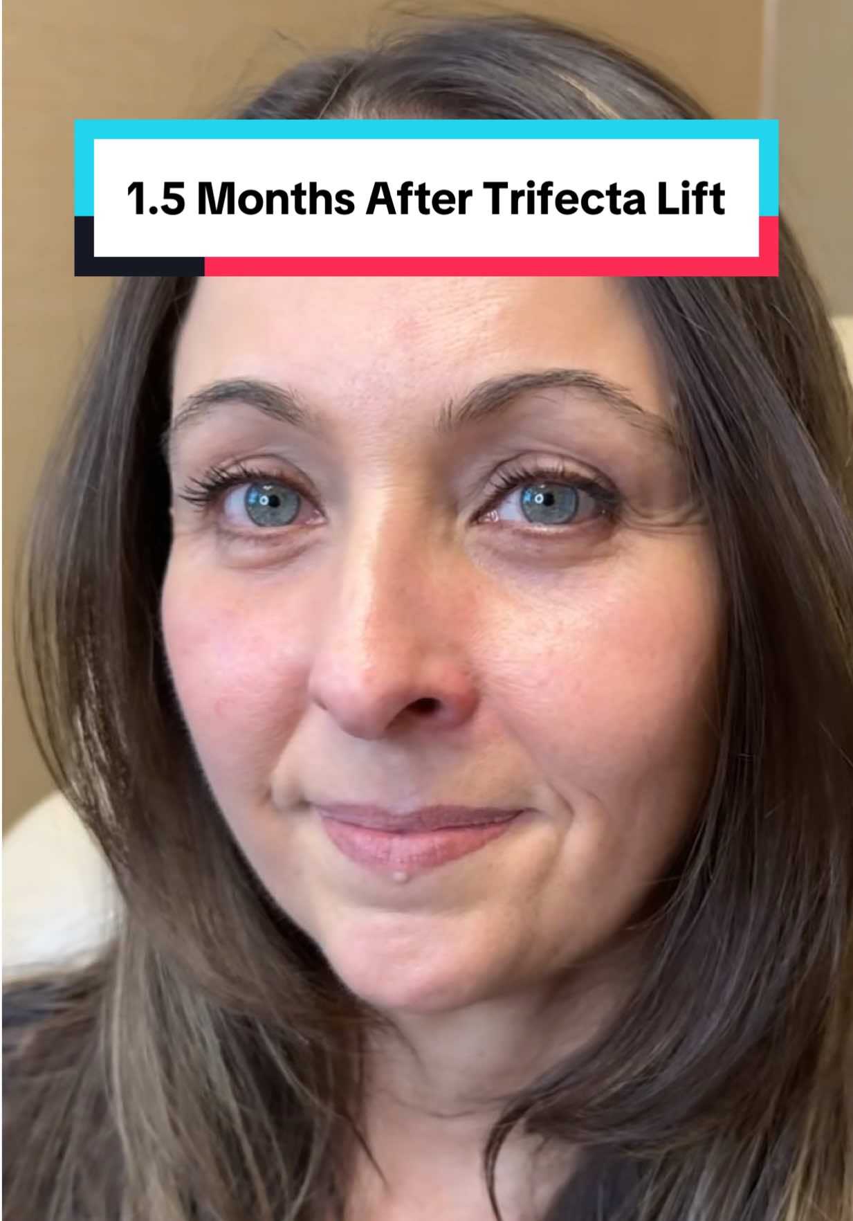 Trifecta Lift = lower blepharoplasty, fat transfer to mid-face + skin tightening 📍Beverly Hills, CA #eyemakeup #holloweyes #eyebags #trifectalift #kamiparsamd 