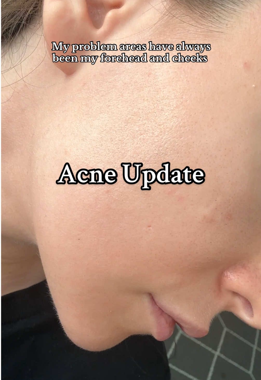 3 month tretinoin/acne treatment update! I’m currently using it every other day. I still get blemishes but have noticed significant improvement since starting use.  #acnetreatment #tretinoinjourney #acne 