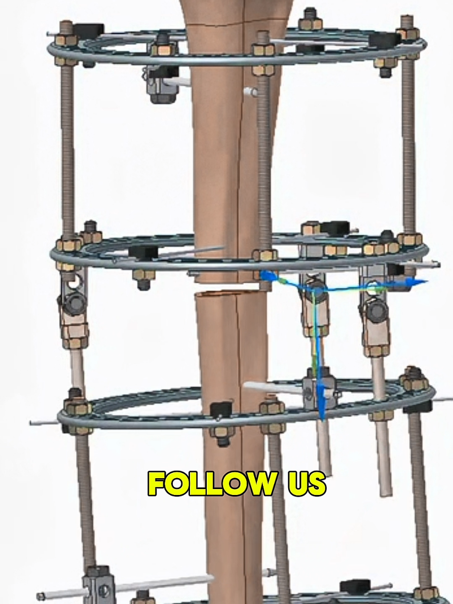 Ilizarov Procedure — Bone Lengthening & Deformity Correction Explained 🦴 #IlizarovProcedure #BoneLengthening #OrthopedicSurgery #MedicalEducation #SurgeryVideo     