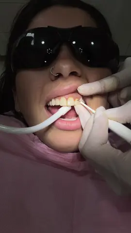 Me voy a hacer carillas!!😍 síganme en este proceso, hoy remodelamos las encías, les seguiré mostrando! @doctoras.guerrero #fy #gingivoplastia 