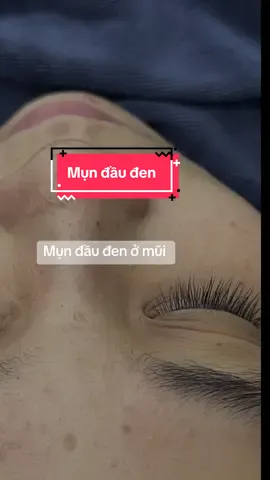Mụn đầu đen ở mũi chỉ là chuyện nhỏ khi qua MC Beauty Center #nặnmunbangtay #lấynhanmunbangtay #Chămdachuẩnykhoa #duocmypham #vairal 