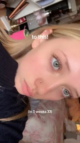 Thank you SkinSmart! If you want glowy skin but struggle with acne or clogged pores this will become your favorite skin care product. #ad #skincare #fyp #acne #acnetreatment 