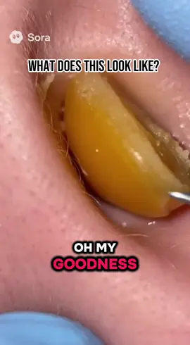 #earcleaning #earwaxremoval #earcleaningasmr #satisfyingvideo #CleanTok 