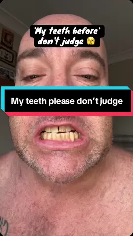 The viral V34 Duo. #hismile #v34duo #teethwhitening #coffeedrinkers #stainedteeth @hismile 