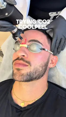 Zapped for clear skin