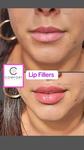 #lip #fillers #hyaluronicacid #juvederm#beforeandafter 
