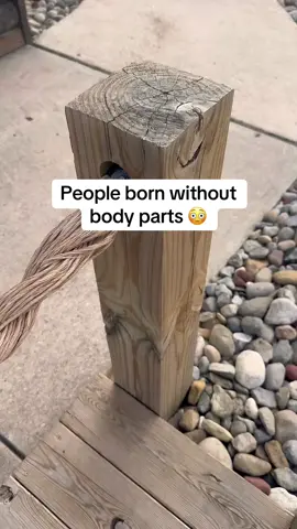 People Born Without Body Parts 😳 #fyp #scary #interesting 