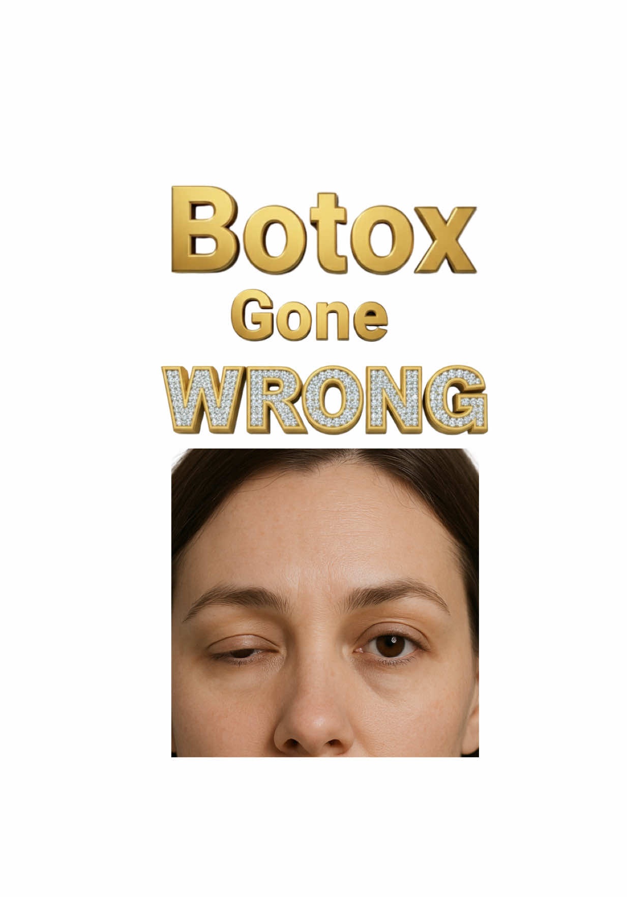 When Botox is injected too low, it can cause eyelid ptosis 👁️ Dr. Kaado corrected it and brought back balance 💉✨ #BotoxFix #EyelidPtosis #BotoxCorrection #KaadoMD #botoxvirginiabeach 