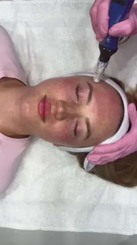 Microneedling walkthrough 💕 #microneedling #woodlandsmedspa #woodlandsesthetician 