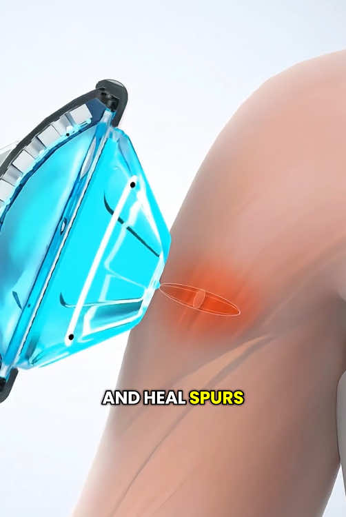 Shockwave Therapy (3D Animation) #shockwavetherapy #shockwave #peyroniesdisease #peyroniestreatment #musclepainrelief #musclepain #scartissuetreatment #medical3danimation #3medicalanimation 