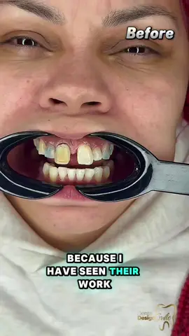 Transform your life with the radiant smile you've always desired.🦷 At our clinic, we offer personalized treatments for every patient, ensuring that each smile is unique and spectacular. 🥼Our team of experts is ready to guide you every step of the way toward your new smile.🌟 Come to Miami and enjoy: • 🏨 4 nights / 5 days luxury stay in 1–2 bedroom apartments • 🚐 Free VIP transportation in Mercedes-Benz vans • ✨ $500 off resin smile design • 💎 $2,000 off porcelain veneers