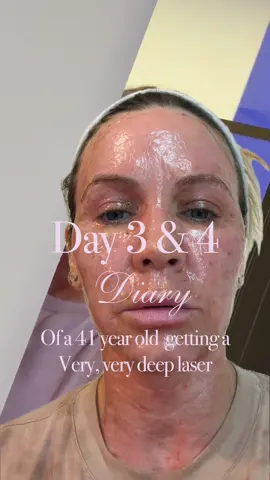 Day 3 and 4 update! Healing pretty fast!!! Got very itchy on the 3rd and 4th day #fyp #laser #beautytreatments #beauty 