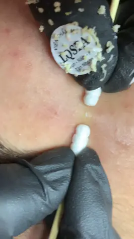 Nhiều mà ẩn núp #chamsocdamun#chamsocdaseo#chamsocdanam#tanbinh#Lqspa&academy