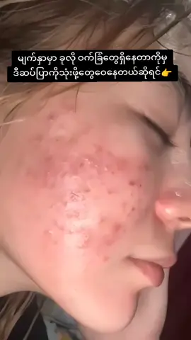 #viber09458460617 #သလဲသီးမျက်နှာသစ်ဆပ်ပြာ #ဝက်ခြံဆားဝက်ခြံအဆီဖုပျောက်ချင်မှသုံး #မြို့ပေါင်း300အိမ်ရောက်ငွေချေပို့ပေးသည် #မသိသာရင်ငွေပြန်အမ်းမယ်💯✅ @မလဲ့💙 