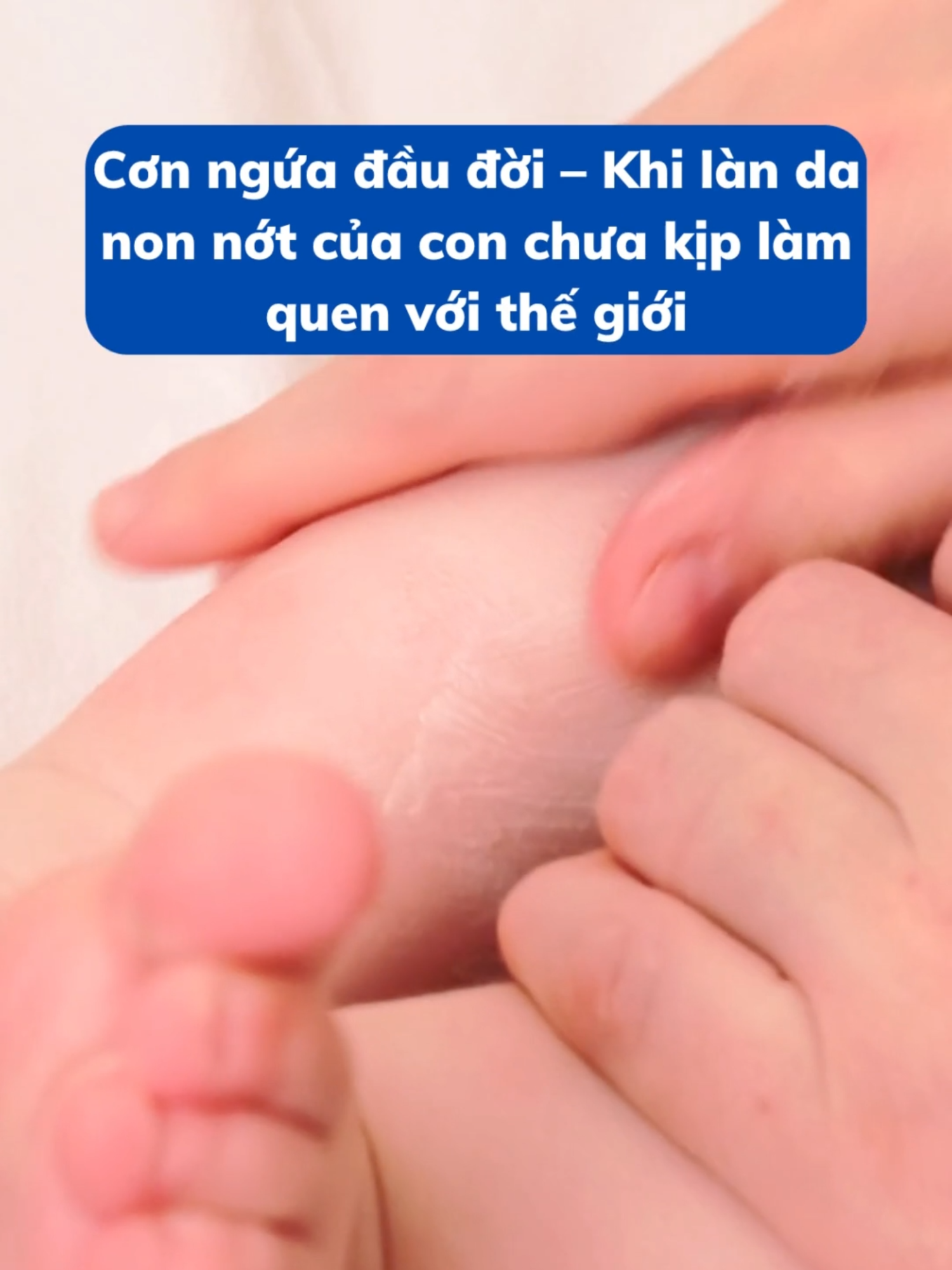 Cơn ngứa đầu đời – Khi làn da non nớt của con chưa kịp làm quen với thế giới #subac #viemda #manngua #mebe #xuhuong #munnuoc #nuoicon