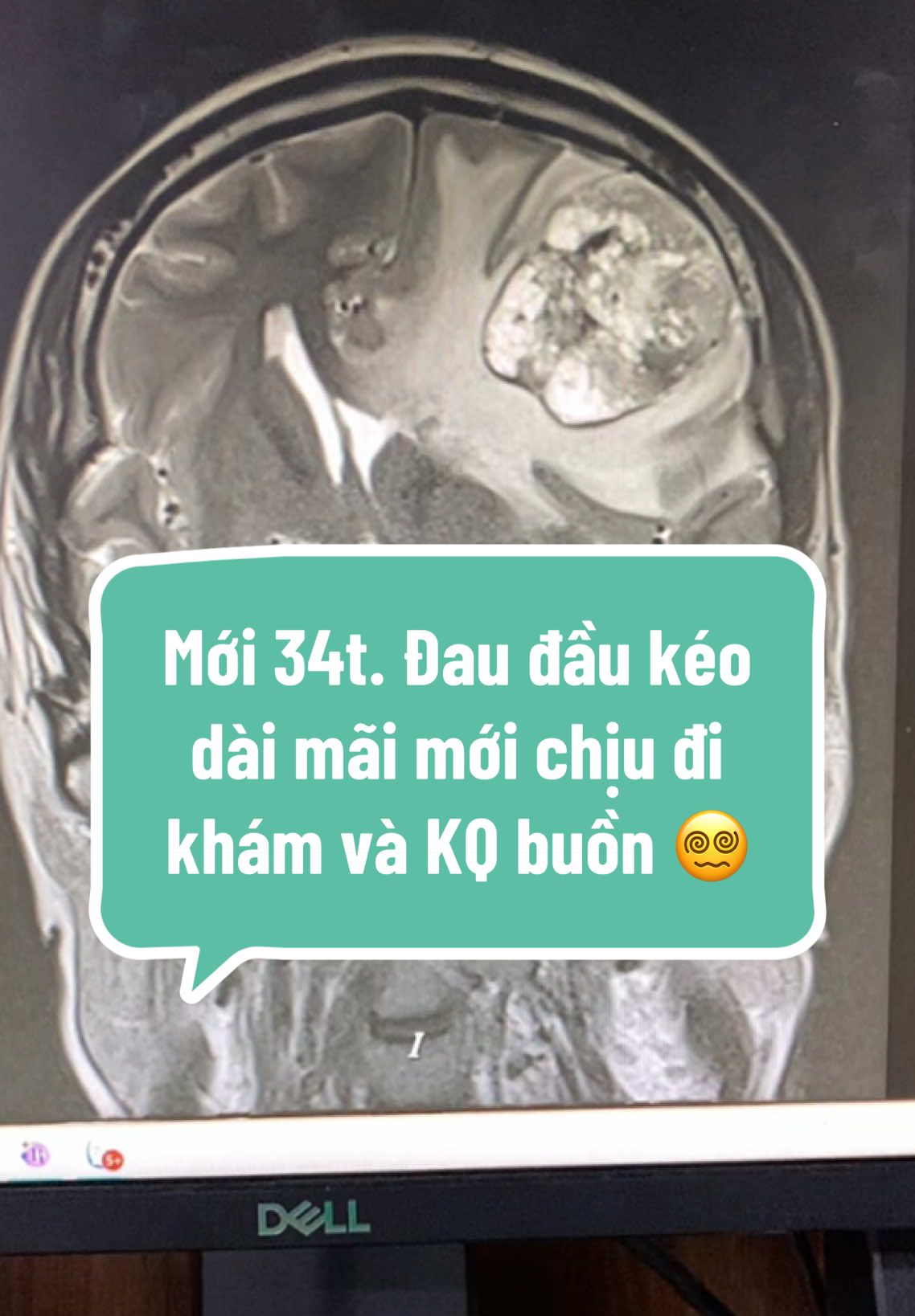 Mới 34t. Đau đầu kéo dài mãi mới chịu đi khám và KQ buồn 😵‍💫#viral #xuhuongtiktok #sức_khỏe_là_vàng #sứckhoẻ #daudau 