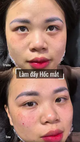 #beauty #xuhuong #pttm #fypシ #filler 
