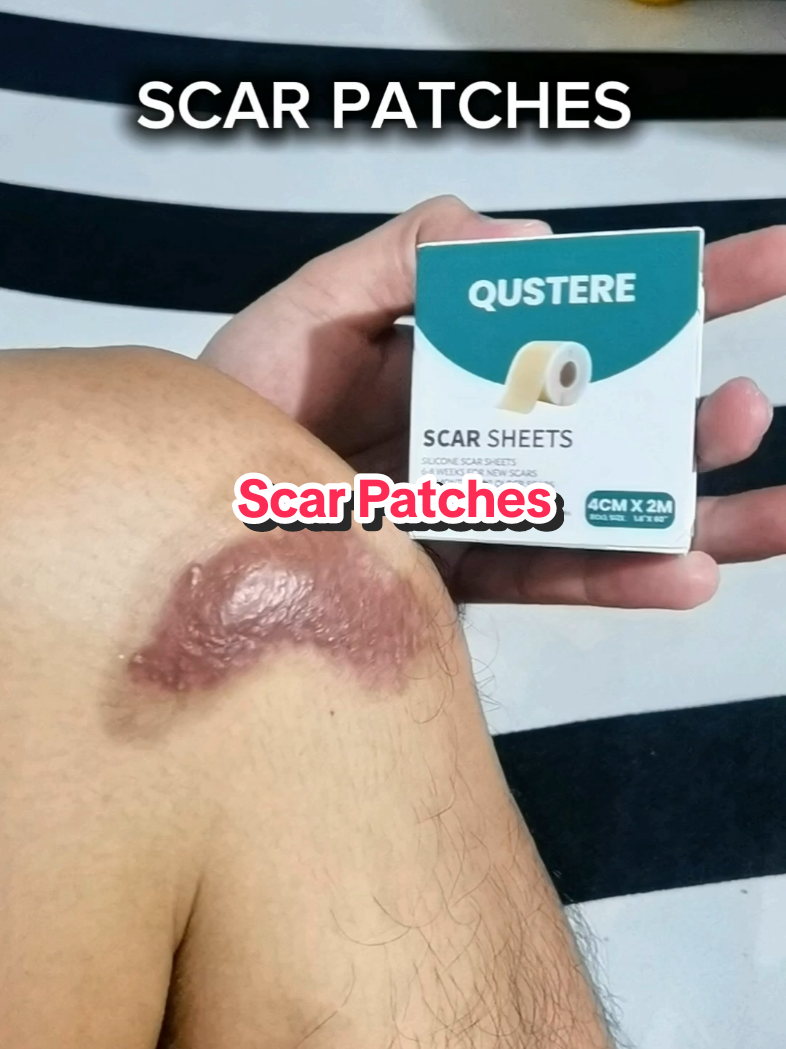 Scar Patches Invisible Repair Gel Patches, Surgical Scar Tapes, Keloids, Acne, Blackheads #scarpatches  #scarsheets #keloid scar removal philippines #surgicaltape #gelpatches 