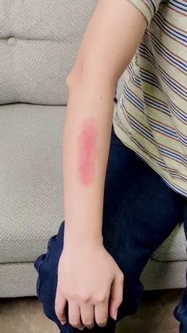 Người ta bảo: Con gái có sẹo thì đừng mặc hở.