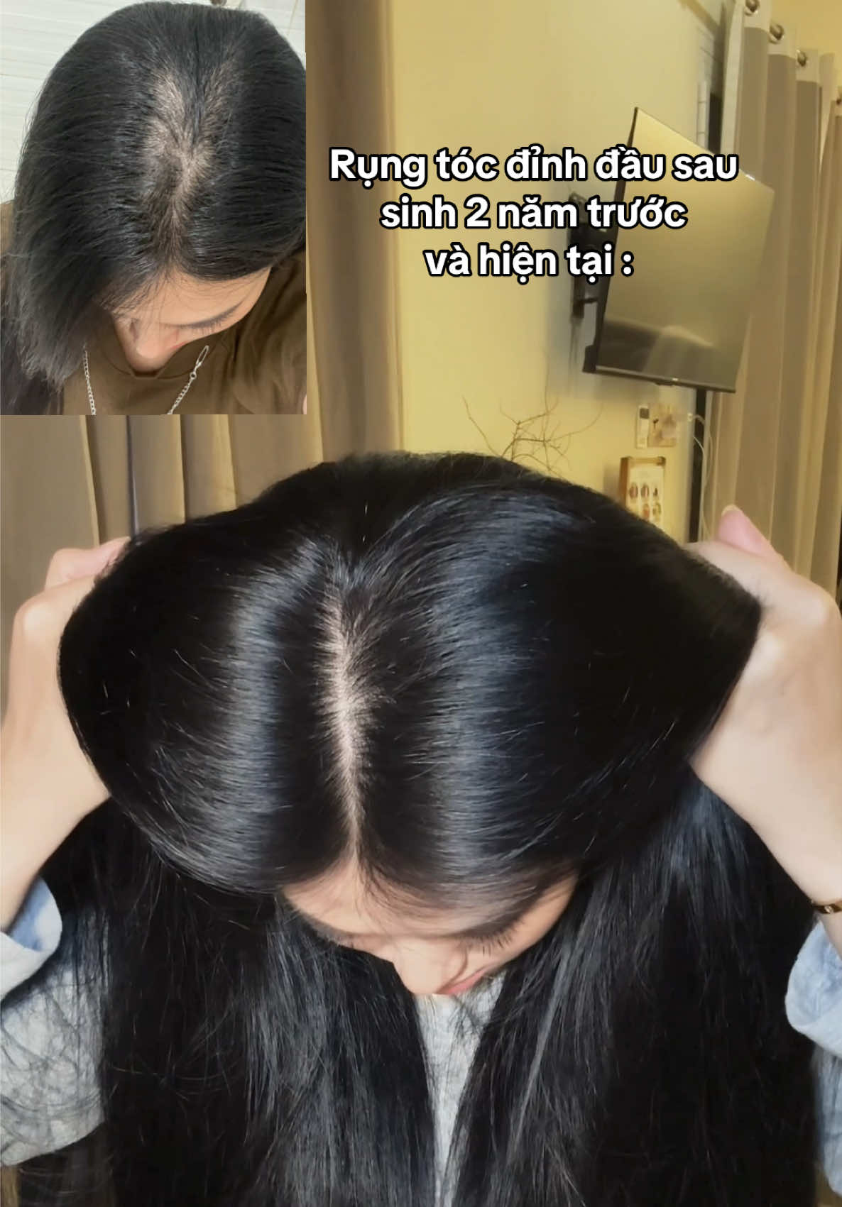 May là chăm tóc kịp lúc không là thành Nhung đầu hói rồi #Dsuri #tocdep #phunusausinh #rungtocsausinh #rungtoc 