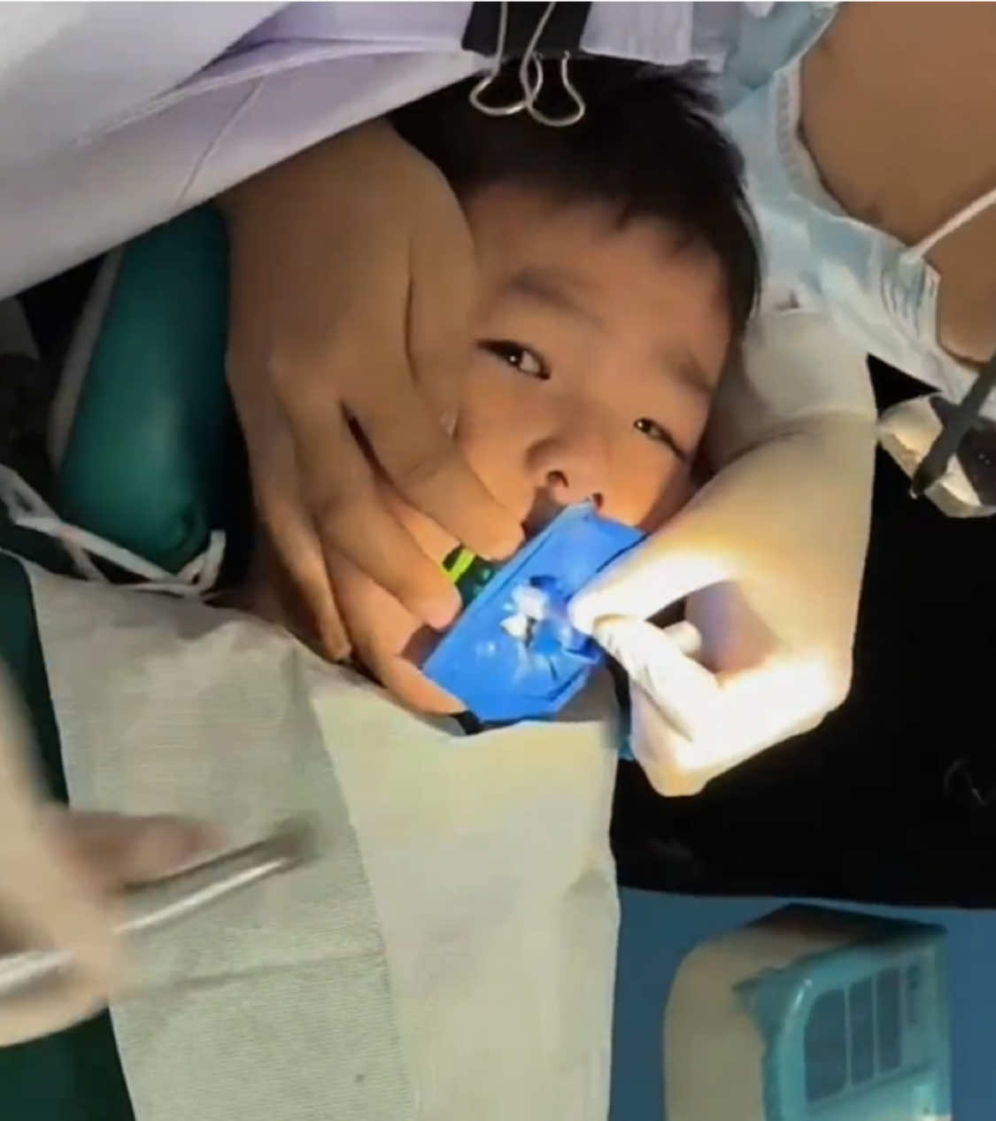 Children having their wisdom teeth extracted#Teeth #Dental #牙齿 #植牙 #牙齿矫正 