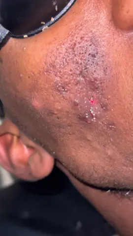 Finanka wajiga qabka lo jaro 🤗##darmatology #follow #foryoupage #borma  @Princess😮‍💨❤️🫶🏻  @𝗔 𝗠 𝗘 𝗜 𝗡٭͜🤴🏽💙🇩🇪  @boorama  dermatology center 