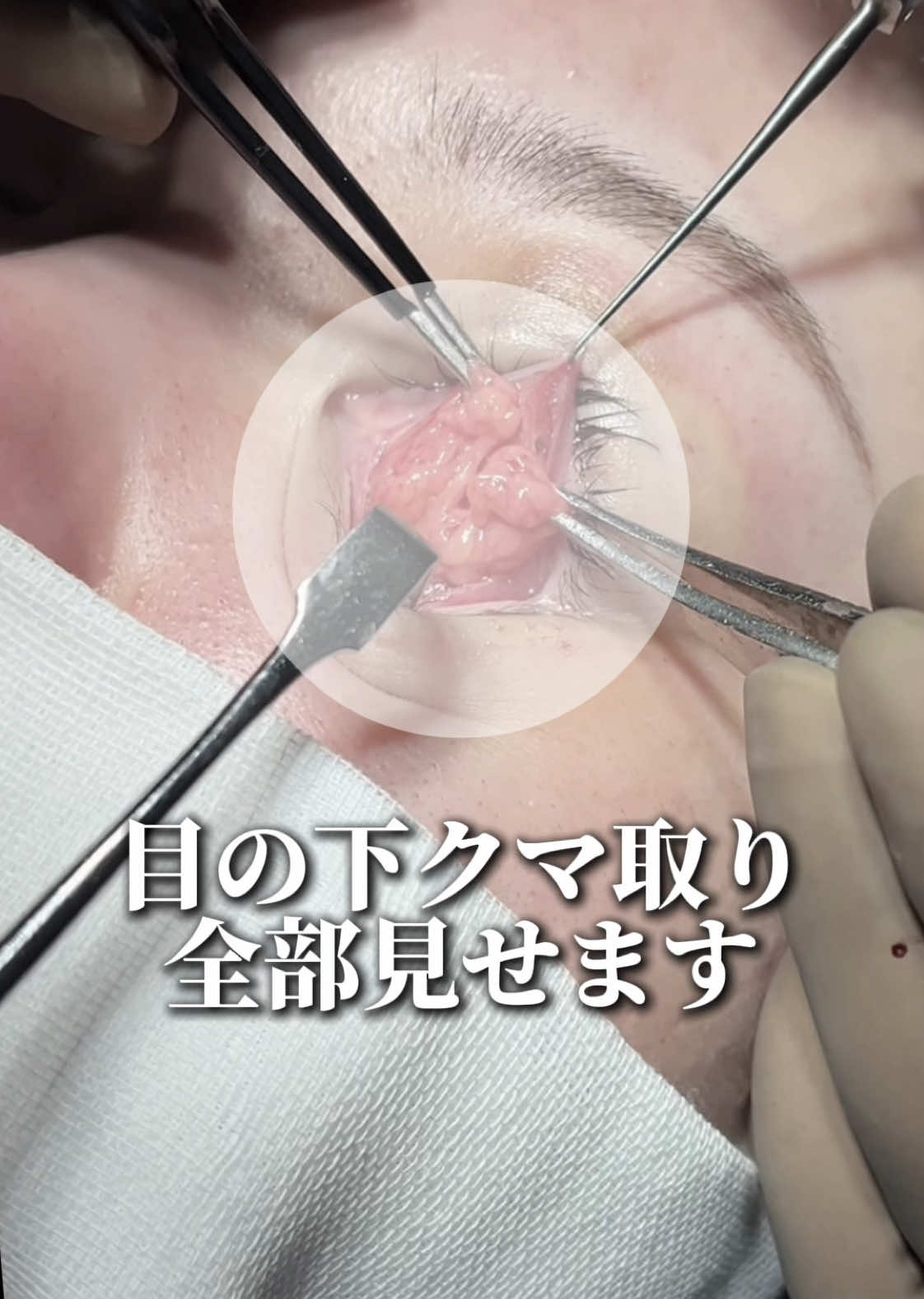 目の下のクマ取り全部見せます#クマ取り#クマ治療#整形